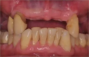 Rehabilitación con implantes y elevación de seno ANTES