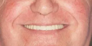 Rehabilitación con implantes y elevación de seno DESPUES 2