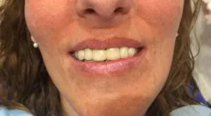 Rehabilitación con prótesis fija, para mejorar malposición dental y reponer ausencias DESPUES