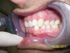 Sobremordida severa ANTES