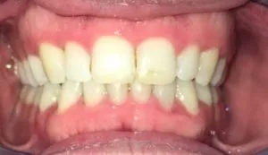 Sobremordida severa DESPUES 2