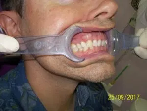 Sobremordida severa DESPUES