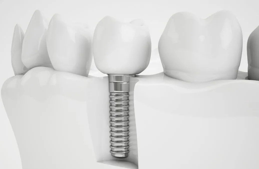 Implantes de carga inmediata e Implantes especiales