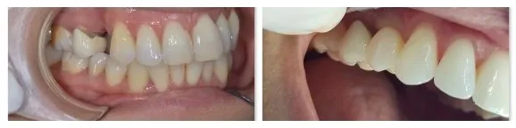 beneficios implantes