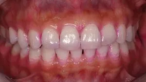 blanqueamiento dental