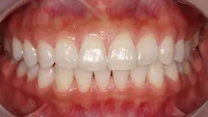 blanqueamiento dental