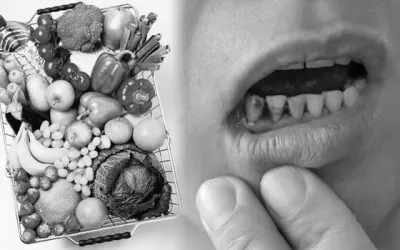 ¿Sangre en las encías?