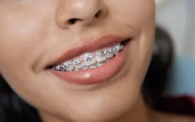 Beneficios de los brackets Damon