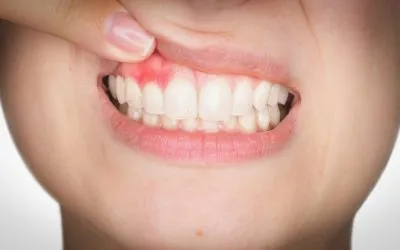 Enfermedades dentales comunes