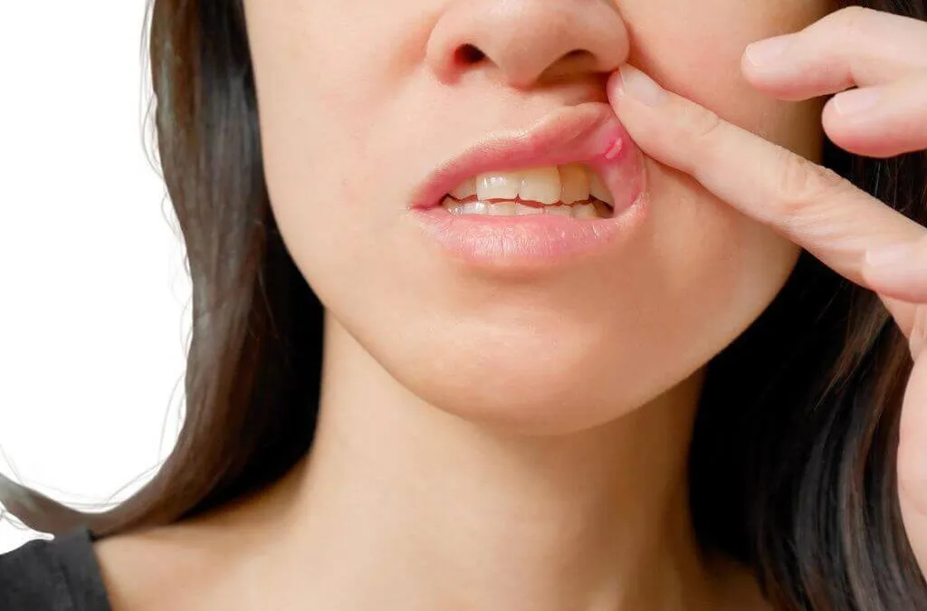 Cáncer de boca ¡Cuídate y previene!