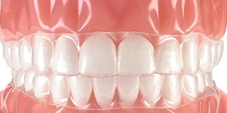 alineadores transparentes