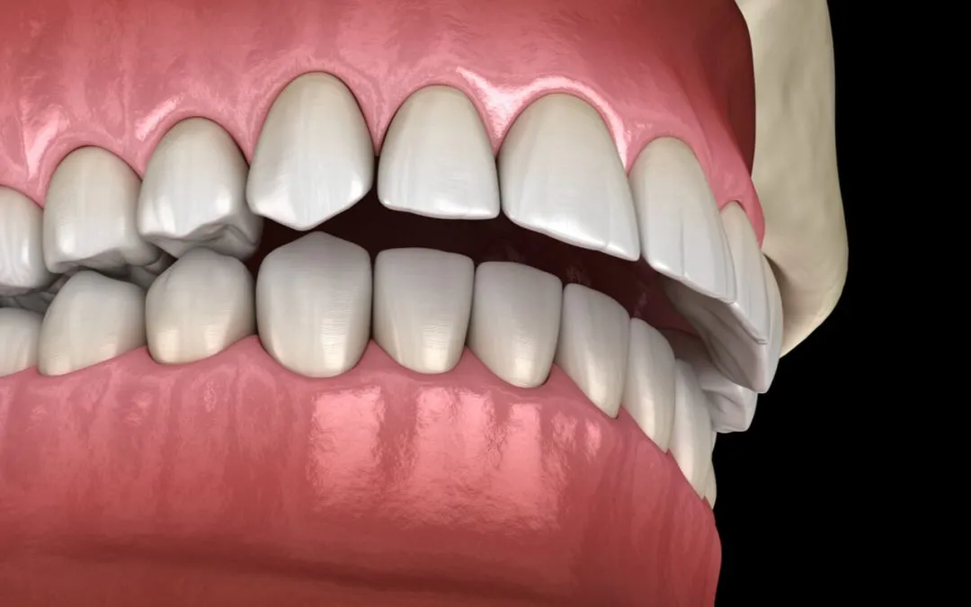 Sobremordida: Diferencias entre Invisalign y brackets