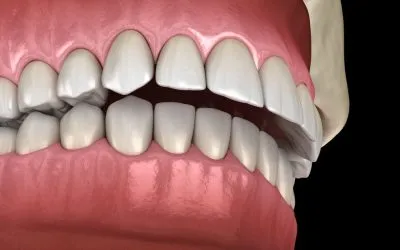 Sobremordida: Diferencias entre Invisalign y brackets