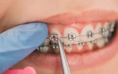 Retención ortodóntica ¿Por qué es tan importante?