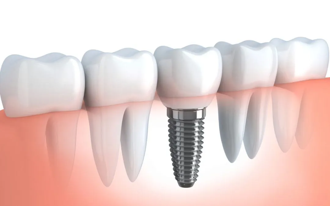 Tipos de implantes dentales