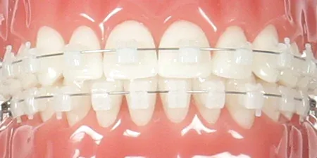 tirantes transparentes