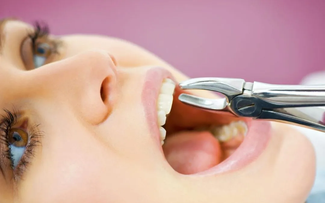 Extracción de las muelas del juicio: ¿cuándo es el mejor momento?