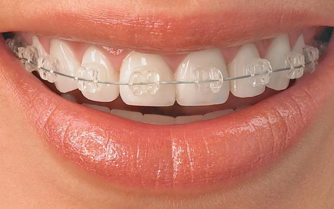 Diferencias entre brackets de cerámica y de zafiro