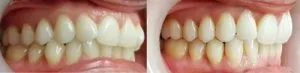 ortodoncia invisible antes y despues