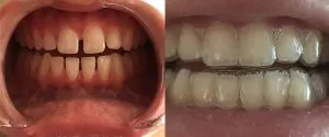 ortodoncia invisible antes y despues
