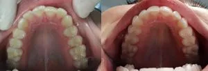 ortodoncia invisible antes y despues