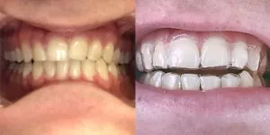 ortodoncia invisible antes y despues