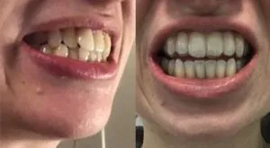 ortodoncia invisible antes y despues