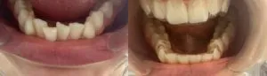 ortodoncia invisible antes y despues 9