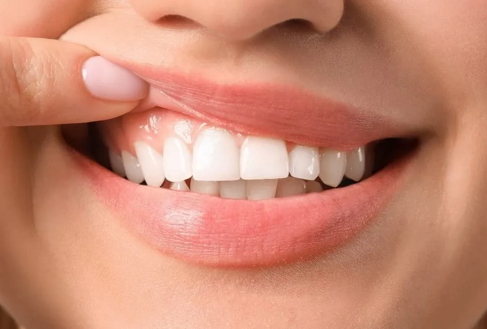 4 causas de los puntos negros en encías