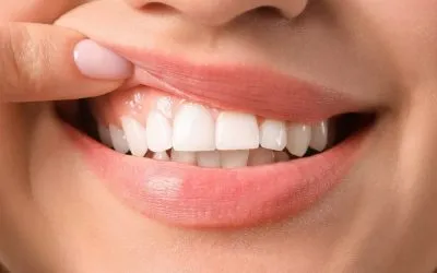 4 causas de los puntos negros en encías