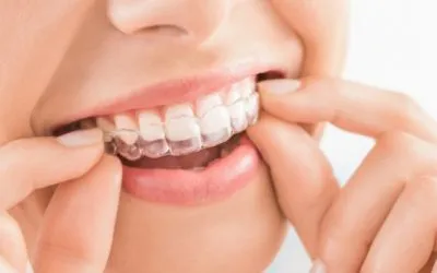 Cuánto cuesta una ortodoncia invisible en España