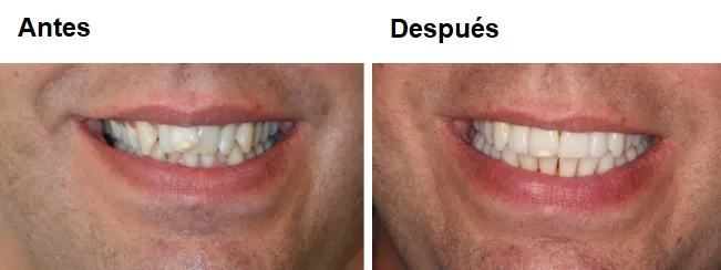 antes y despues invisalign