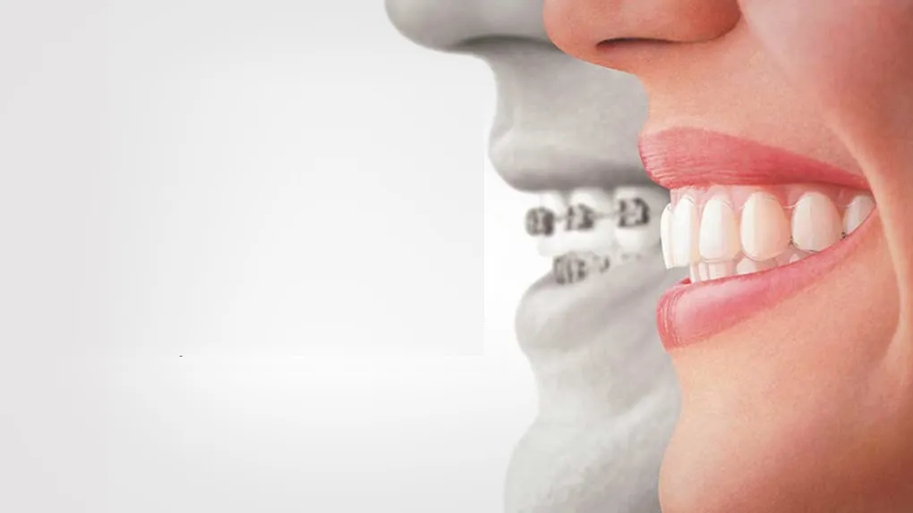 Ortodoncia Invisible marcas