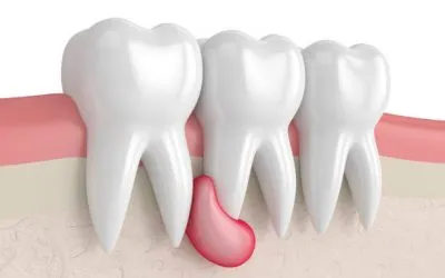 Todo lo que necesita saber sobre los quistes de las encías