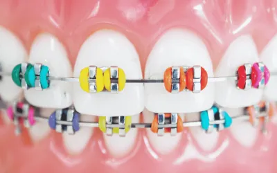 Color de brackets para que los dientes se vean blancos