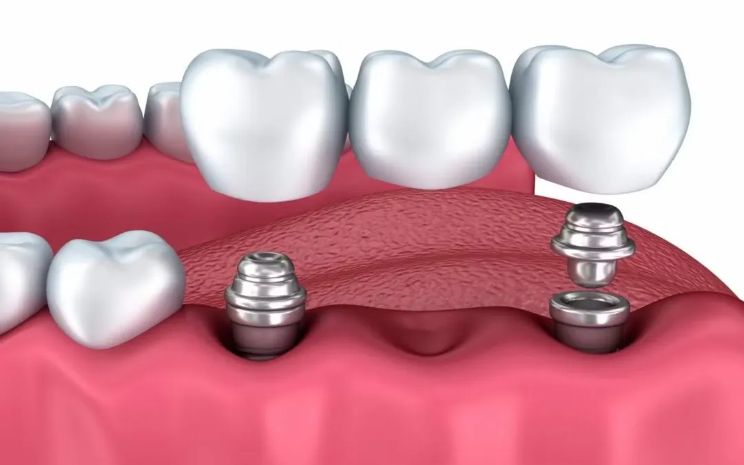 ¿Qué son los implantes dentales?
