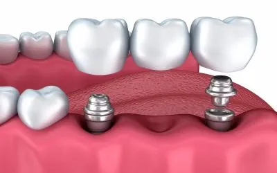 ¿Qué son los implantes dentales?