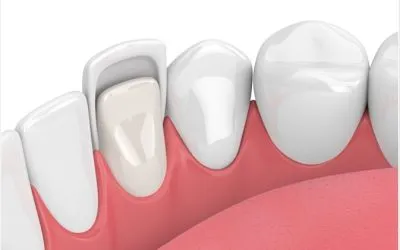 Carillas dentales: 12 recomendaciones para su cuidado