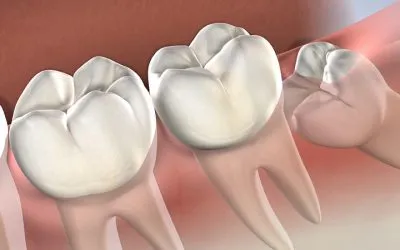 ¿Qué sucede si nunca se extraen las muelas del juicio?