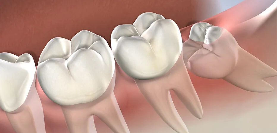 ¿Qué sucede si nunca se extraen las muelas del juicio?