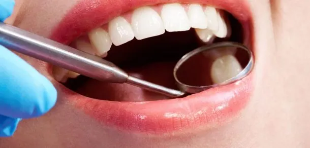 Beneficios y Que son las carillas dentales