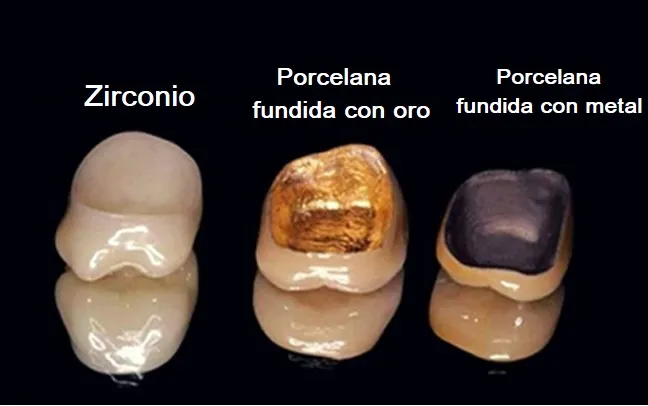 Coronas de zirconio
