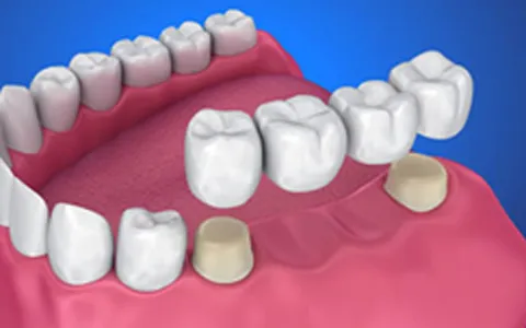 puente dental
