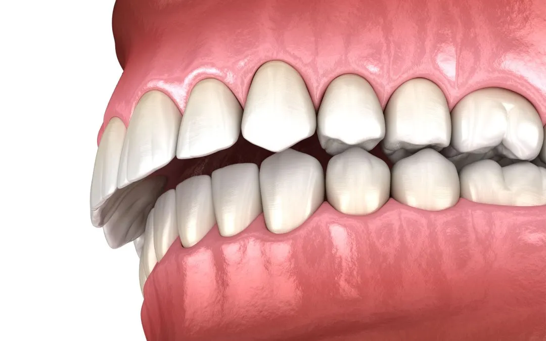 Guía para la sobremordida: qué es, qué la causa y cuáles son las opciones de tratamiento