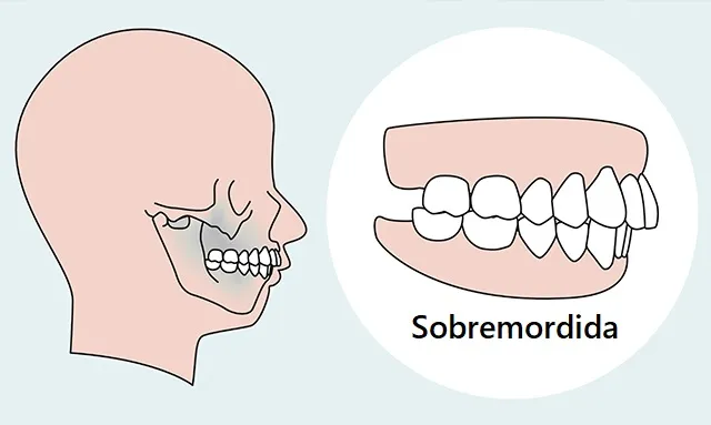 Tipos-de-sobremordidas clinica dental GrupoGenteVital