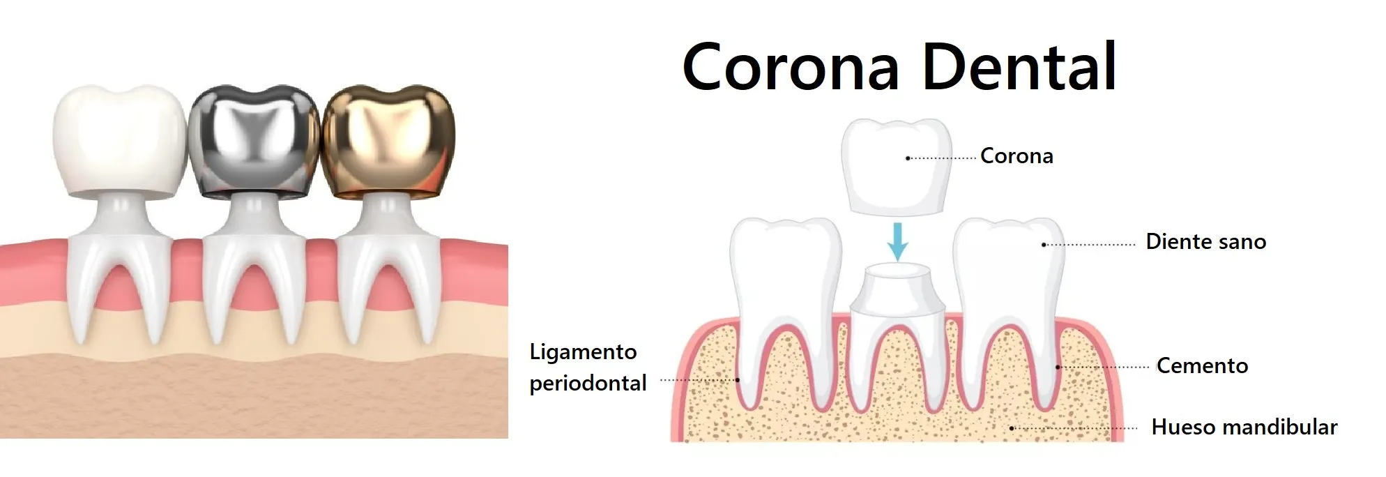 Protesis dental precio, coronas dentales
