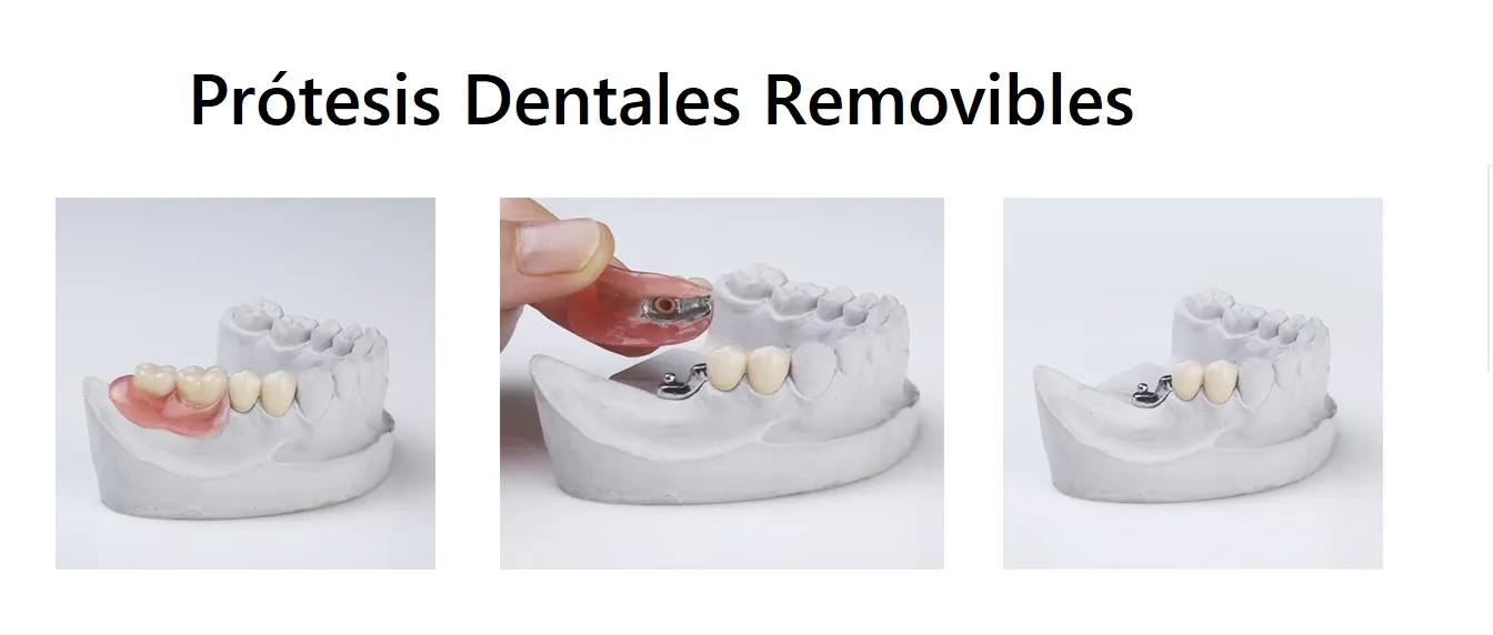 prótesis dentales removibles